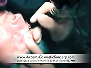 Еще немного о пластике век