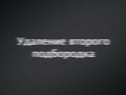 Избавляемся от второго подбородка за счет липосакции