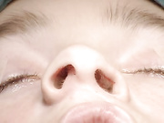 Ринопластика