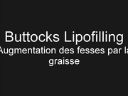 Липофилинг придаст форму ягодицам