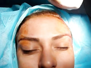 Лифтинг бровей с использованием нитей