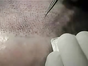 Пересадка волос - как это происходит