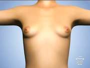 Современная коррекция размеров и форм груди