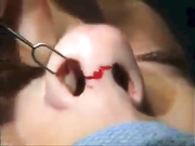 Методика закрытой ринопластики