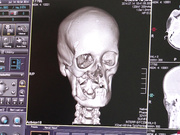 Томограмма - Хирург Валихновский ведёт Татьяну делать тоамограмму. Состояние её костей шокирует.
