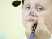 [Юлия Михейкина] Разметка перед операцией.