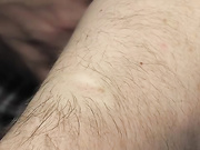 Как удаляют шрамы и рубцы с помощью лазера