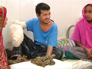 Человек дерево пройдет пластическую операцию