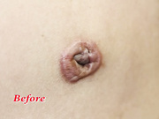 Принцип проведения процедуры по коррекции пупка