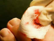 Как проводится операция при вросшем ногте