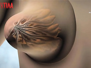 Мужчина 20 лет живет с паховой грыжей размером с тыкву - Я соромлюсь свого тіла