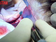 У 17-летней девушки чрезмерно разрастаются десны - Я соромлюсь свого тіла